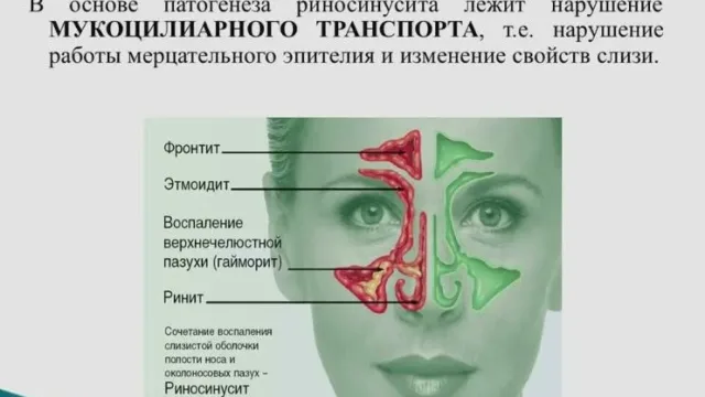 Как вылечить насморк в домашних условиях