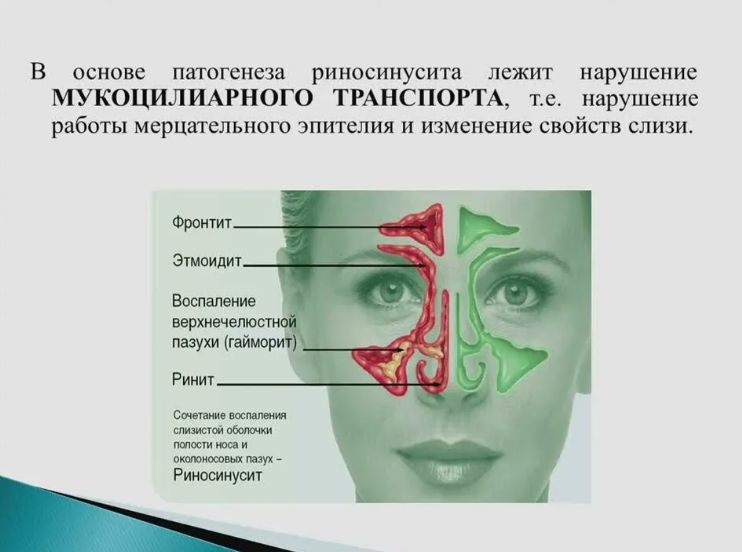 Как избавиться от насморка в домашних условиях